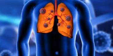 akciger-kanserinde-cerrahi-yontem-hayat-kurtariyor