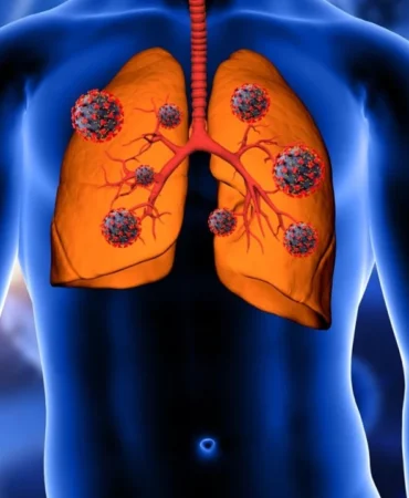 akciger-kanserinde-cerrahi-yontem-hayat-kurtariyor