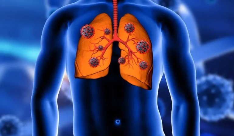 akciger-kanserinde-cerrahi-yontem-hayat-kurtariyor