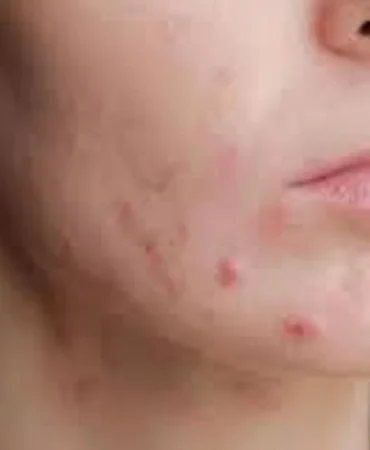 akne-sivilce-olumusu