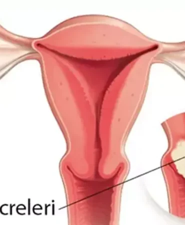 rahim-agzi-kanserine-karsi-hayat-kurtaran-4-kritik-onle