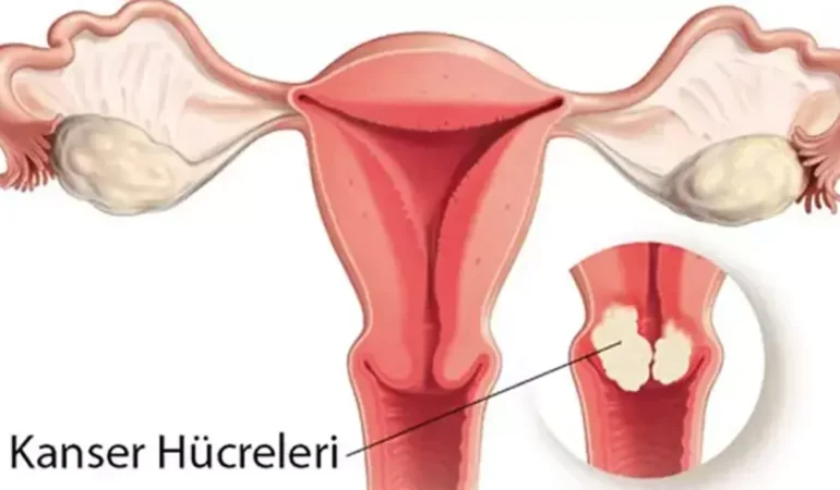 rahim-agzi-kanserine-karsi-hayat-kurtaran-4-kritik-onle
